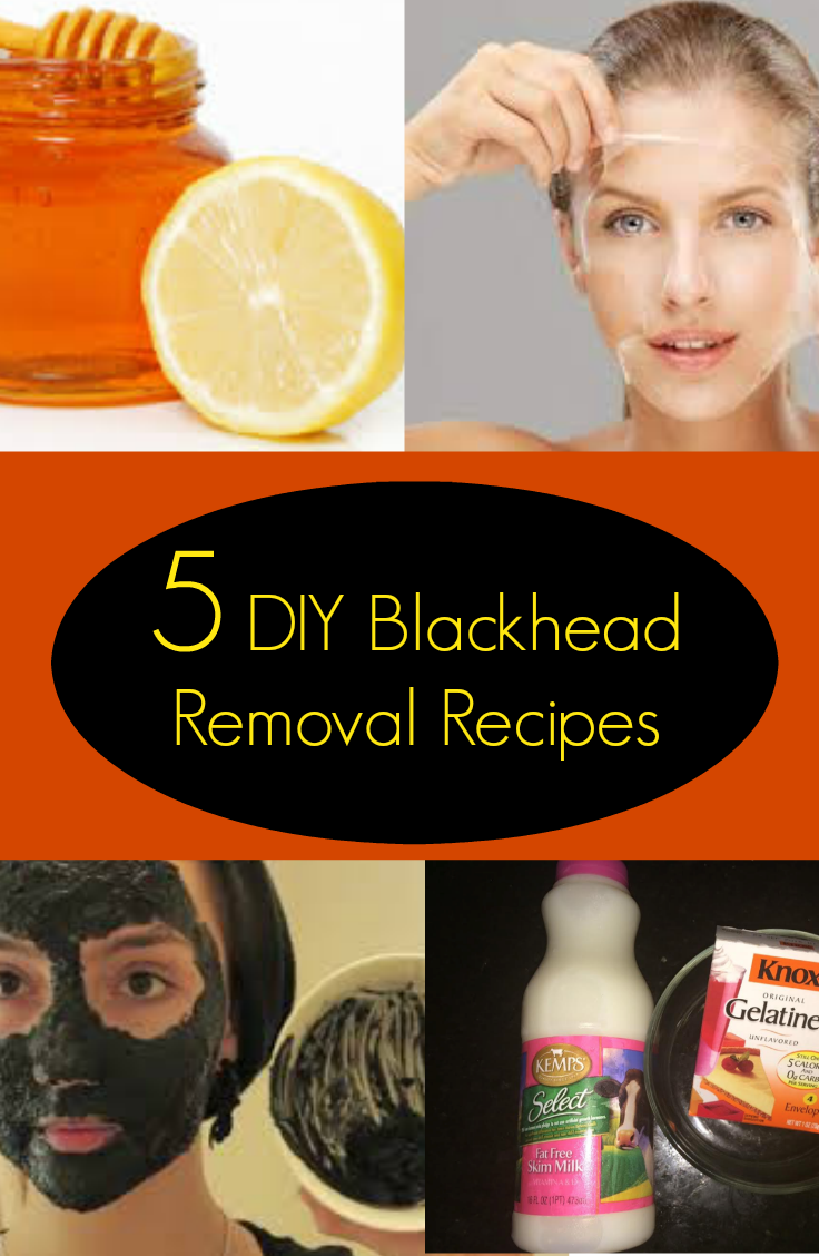 5 DIY Blackhead Removal Recipes | DiscountQueens.com